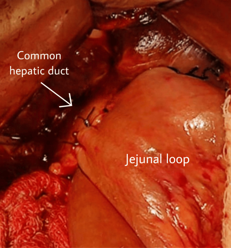 Anastomosis between the jejunum and common hepatic duct