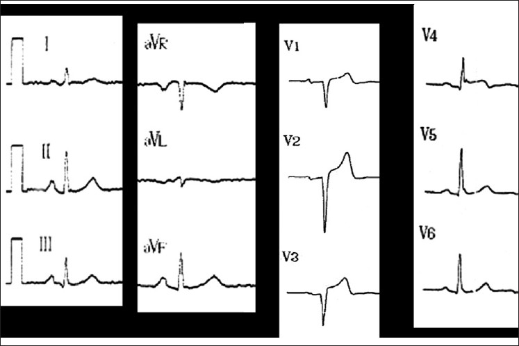 Electrocardiogram of Case 2, which shows anterior ST elevation (V2-V3)