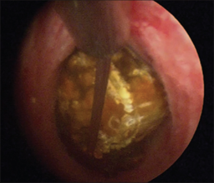 Common bile duct stone removal with Triprong grasper