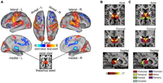 Thalamic dysconnectivity in SCZ. (A) Significant whole-brain between-group differences in thalamic connectivity between healthy controls (CON) and individuals with schizophrenia (SCZ). Red-orange (blue) foci mark areas where patients exhibited stronger (reduced) thalamic coupling. (B) Intrinsic thalamic dysconnectivity pattern based on group dissimilarity. The brightest voxels are associated with highest between-group differences. (C) Thalamus subdivisions based on the FSL thalamic atlas, defined by their connectivity to different regions of cortex. White arrows indicate the correspondence between thalamic regions with greatest dysconnectivity in SCZ and thalamic subdivisions strongly connected with prefrontal cortex (red). Adapted from Anticevic et al. (2014a).