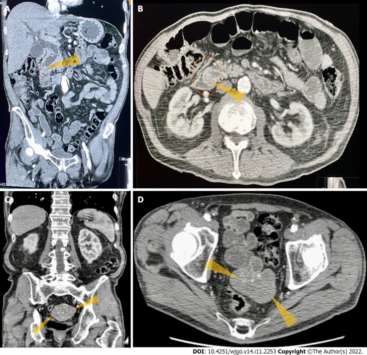 Computerized tomography of the abdomen and pelvis with contrast images. A: Computerized tomography (CT) abdomen and pelvis with contrast. Coronal section shows obstructed distal common bile duct (CBD) due to a 9 mm polypoid intraluminal (pointed yellow arrows) lesion in the distal CBD; B: CT of the abdomen and pelvis with contrast. Axial section shows polypoid, soft tissue mass at the level of distal common bile duct (pointed yellow arrows); C: CT of the abdomen and pelvis with contrast. Heterogeneously enhanced lobulated mass with punctate calcifications (pointed yellow triangles) in the posterior pelvis originating from the serosal surface of the pelvic small bowel; D: CT of the abdomen and pelvis with contrast. Axial section shows a heterogeneously enhanced lobulated mass with punctate calcifications (pointed yellow triangle) in the posterior pelvis originating from the serosal surface of the pelvic small bowel.