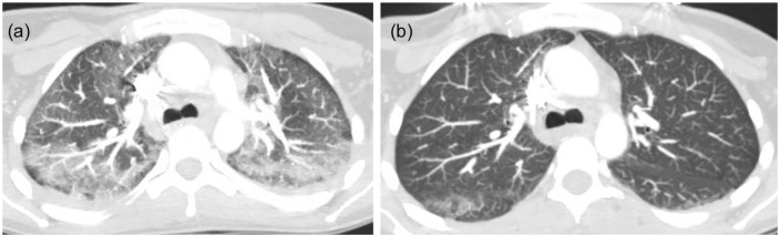 (a) Pretreatment—bilateral upper lobe patchy ground-glass infiltrates. (b) Posttreatment—interval improvement of patchy bilateral upper lobe infiltrates with small residual superior segment right lower lobe ground-glass opacity.