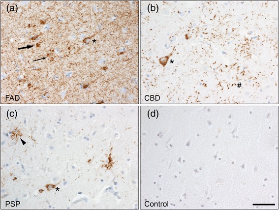 Tau pathology in frontal cortex as showed with the AT8 antibody. a APPswe mutation carriers show AT8 immunoreactivity in neurofibrillary tangles (arrow), pretangles (asterisk), neuropil threads and dystrophic neurites around amyloid plaques (small arrow). b AT8 immunohistochemistry revealed diffuse cytoplasmic tau immunoreactivity in neurons (pretangles, asterisk) and astrocytic plaques (#) in CBD patients, while c PSP patients show AT8 immunoreactivity in pretangles (asterisk) and tufted astrocytes (arrowhead). d No AT8 immunoreactivity was detected in control individuals. Scale bar: 50 μm