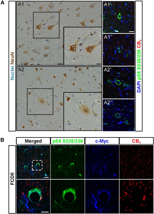 CB1 receptors are present in undifferentiated cells. (A) Dysplastic neurons (A1,A1′,A1″) and balloon cells (A2,A2′,A2″) were identified based in morphological criteria in hematoxylin/eosin sections stained with NeuN antibody (A1,A2). CB1 receptor expression and mTORC1 activity status were analyzed by immunofluorescence with CB1 and phospho-S6 antibodies, respectively (A1′,A1″,A2′,A2″). (B) Representative immunofluorescence images showing the presence of CB1 receptor (red) in FCD Type II brain cells labeled with the undifferentiated cell marker c-Myc (blue) and active mTORC1 signaling phospho-S6+ cells (green). High magnification insets are shown (lower panels). Scale bar: 25 μm, insets, 10 μm.