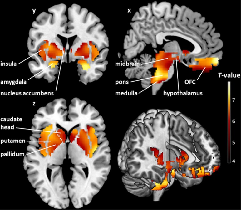 Brain regions where cannabinoid 1 receptor (CB1R) availability covaries negatively with log body mass index (BMI) in patients with food intake disorder (FID). T map of significant negative correlations between CB1R availability and log BMI in predefined homeostatic and reward-related regions of interest shown at a threshold of PFWE-corrected<0.05 (both on the voxel and cluster levels; n=54). The colored voxel-based statistical parametric mapping (SPM) results of the negative correlations in sagittal (x), coronal (y) and transverse (z) sections are overlaid on a normalized canonical image (ch2better-template) available in the MRICron software. The color bar expresses T-score levels.