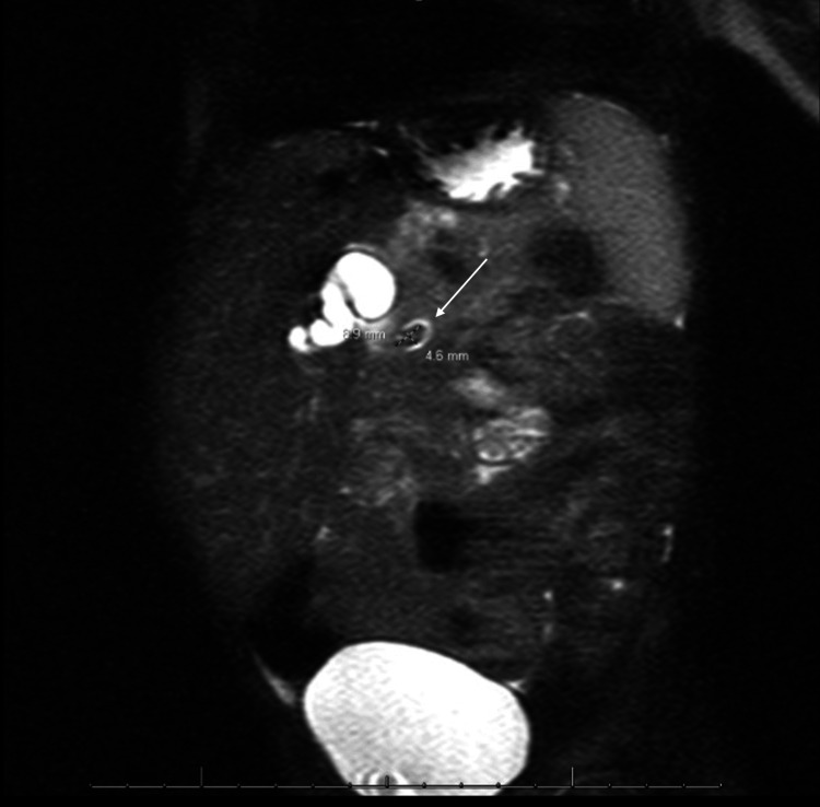 MRCPMRCP showing the gallbladder distended with multiple gallstones, trace amount of free fluid adjacent to the liver, and moderate intra- and extrahepatic biliary ductal dilatation with the common hepatic duct measuring 13 mm in diameter and an ovoid filling defect measuring 9×5 mm in the distal common bile duct (white arrow).MRCP: magnetic resonance cholangiopancreatography