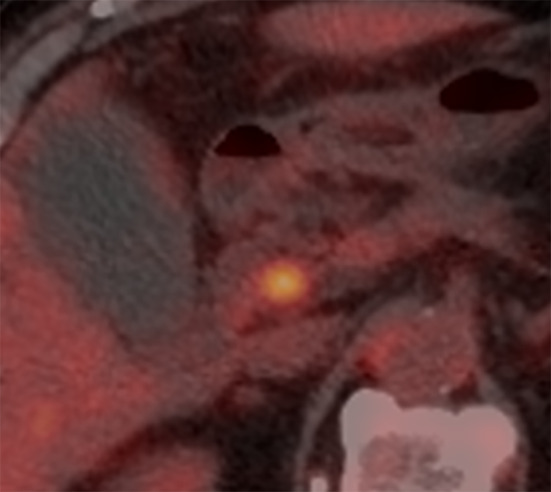 Preoperative positron emission tomography-computed tomography. A focal hypermetabolic lesion (SUVmax 4.2) around the proximal common bile duct is revealed without distant metastasis.
