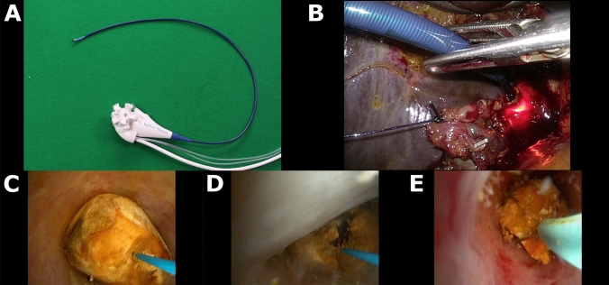Leveraging Access to Technology (LAT). A, an example of an ultra-thin choledochoscope (pictured: SpyGlass™ Discover, Boston Scientific, Marlborough, MA, USA). B, insertion of a 9.5F access sheath for transcystic access with ultra-thin choledochoscope intubating the cystic duct. C, large common bile duct stone with laser probe in position to perform lithotripsy. D, fragmentation using laser lithotripsy. E, removal of fragments with basket