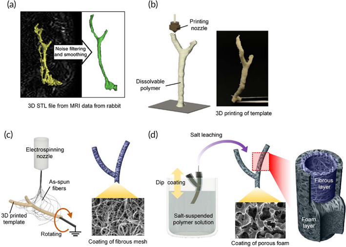 Overall procedures for bioengineering of 3D patient‐specific cell‐laden artificial bile duct construct. (a) 3D design of target bile duct on the basis of magnetic resonance imaging (MRI) data. (b) Fabrication of water‐soluble sacrificial template using material extrusion‐based 3D printing process according to 3D model data. (c) Inner layer formation of fiber mat by electrospinning onto 3D printed template. (d) Outer layer formation of porous foam by dip coating in salt‐suspended polymer solution and salt leaching