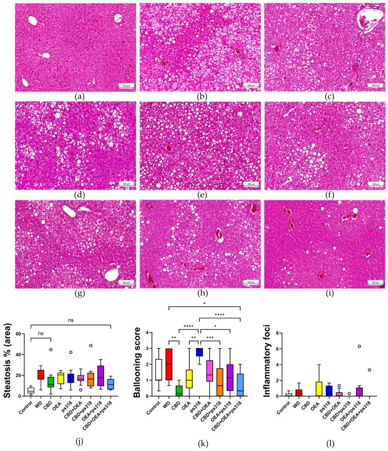 Liver histopathology following cannabinoid treatments. Representative H&E-stained sections for each of the treatments: (a) Control; (b) WD; (c) CBD; (d) OEA; (e) ps318; (f) CBD+OEA; (g) CBD+ps318; (h) OEA+ps318; and (i) CBD+OEA+ps318. (j) Total steatosis percentage area was quantified and all treatment groups except for CBD and the triple combination were statistically significant to the Control group. (k) For hepatocyte ballooning, only the CBD and the triple combination had scores that were statistically significantly different from the WD group. (i) Number of inflammation foci. Circle points indicate outliers which were not included in statistical analysis. All data was analysed through non-parametric analysis. Statistical analyses of data (see Section 4.7 for details): (k) data was normally distributed; 2 outliers were removed from the CBD data and 1 from the ps318 data; (j,l) were not normally distributed. Statistical comparisons were performed relative to the WD group unless otherwise specified. Abbreviations: ns, not significant; *, p < 0.05; **, p < 0.01; ***, p < 0.001; ****, p < 0.0001; WD, Western-style fast-food diet.