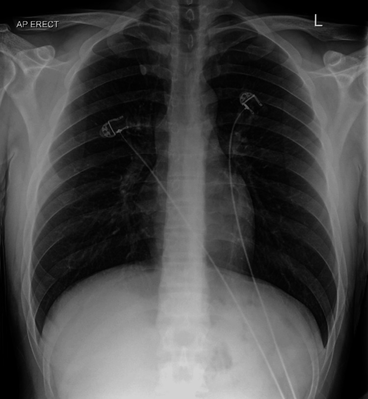 Follow-up chest X-ray showing the resolution of surgical emphysema or pneumomediastinum.