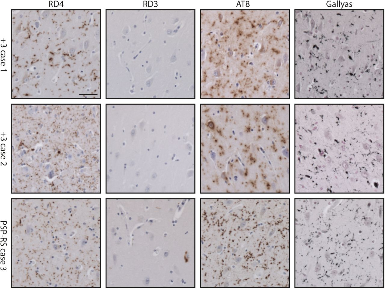 Argyrophilic grains in the entorhinal cortexTau staining with antibodies RD4 (4R tau), RD3 (3R tau), AT8 (pS202/pT205 tau), as well as Gallyas-Braak silver, of the entorhinal cortex from cases 1 and 2 of MSTD (+3 intron 10 mutation in MAPT) and from case 3 of PSP-RS. Scale bar, 50 μm.