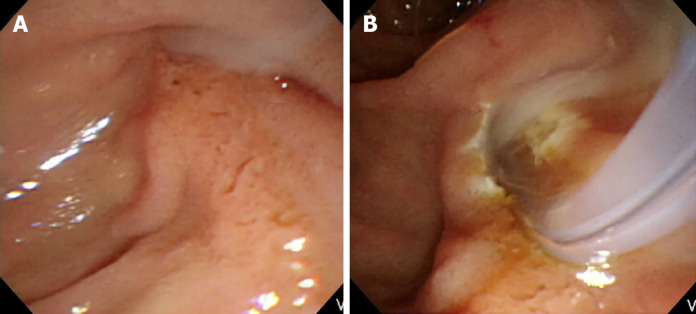 Endoscopic finding of pus in the common bile duct in patients with Mirizzi syndrome. A: The pus is extruding from the ampulla of Vater during endoscopic retrograde cholangiopancreatography; B: The pus is observed from the ampulla of Vater after an endoscopic sphincterotomy.