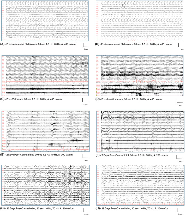EEG during the drowsiness and frequent seizures. This patient was recorded few days after the symptoms began. Continuous high amplitude, diffuse, irregular spike–wave complexes with higher amplitude over bilateral frontal regions, in sequences with a rhythmic‐recruiting pattern (A). Oromucosal midazolam was administered without significant changes (B). After 1 day EEG still showed continuous spike and waves discharges, EMG channels show multiple asynchronous and asymmetric myoclonic jerks over bilateral deltoids, and neck muscles. The patient was also presenting head drops typically seen in NCSE (minor motor status). Both valproate (C) and levetiracetam (D) were ineffective. He started Epydiolex CBD and after 2 days (E) and 7 days (F) there was a marked reduction of EEG epileptiform abnormalities and a resolution of NCSE. After 15 days (G) still some repetitive spikes were evident over asynchronous bilateral temporal and parietal regions. After 29 days (H), there was an improvement of background activity, further reduction in epileptiform abnormalities and the patient was persistently free from seizures.
