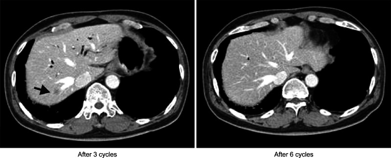 Serial follow-up computed tomography scan shows regression of hepatic lesion in S7 segment.