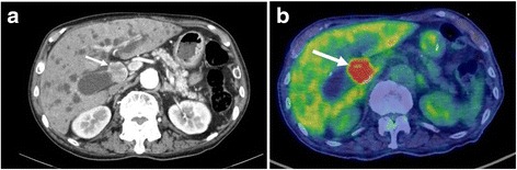 CT (early phase) and FDG-PET findings. a CT showed an enhanced mass that was approximately 2.5 cm in size located in the mid-CBD (arrow). b FDG-PET showed a high accumulation of FDG with a maximum standardized uptake value (SUVmax) of 20.7 in the CBD tumor (arrow)