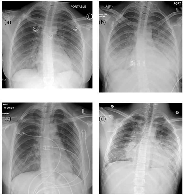 Chest radiographs for case 1 (images a and b with just more than 24 h in between the two radiographs) demonstrating bilateral perihilar opacities and an ill-defined opacity at the left base (a), which rapidly progressed to prominent bibasilar hazy opacities (b). Chest radiograph for case 2 (image c) displays prominent perihilar and bibasilar interstitial opacities with subtle diffuse background reticular and linear interstitial prominence. Chest radiograph for case 3 (image d) shows bilateral perihilar and bibasilar consolidative and patchy opacities, left more so than right, with more diffuse prominence of the reticular pattern.