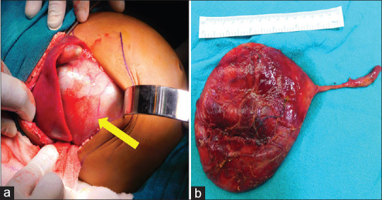Intraoperative picture of the same patient showing giant choledochal cyst (yellow arrow) (a) and resected specimen (b)