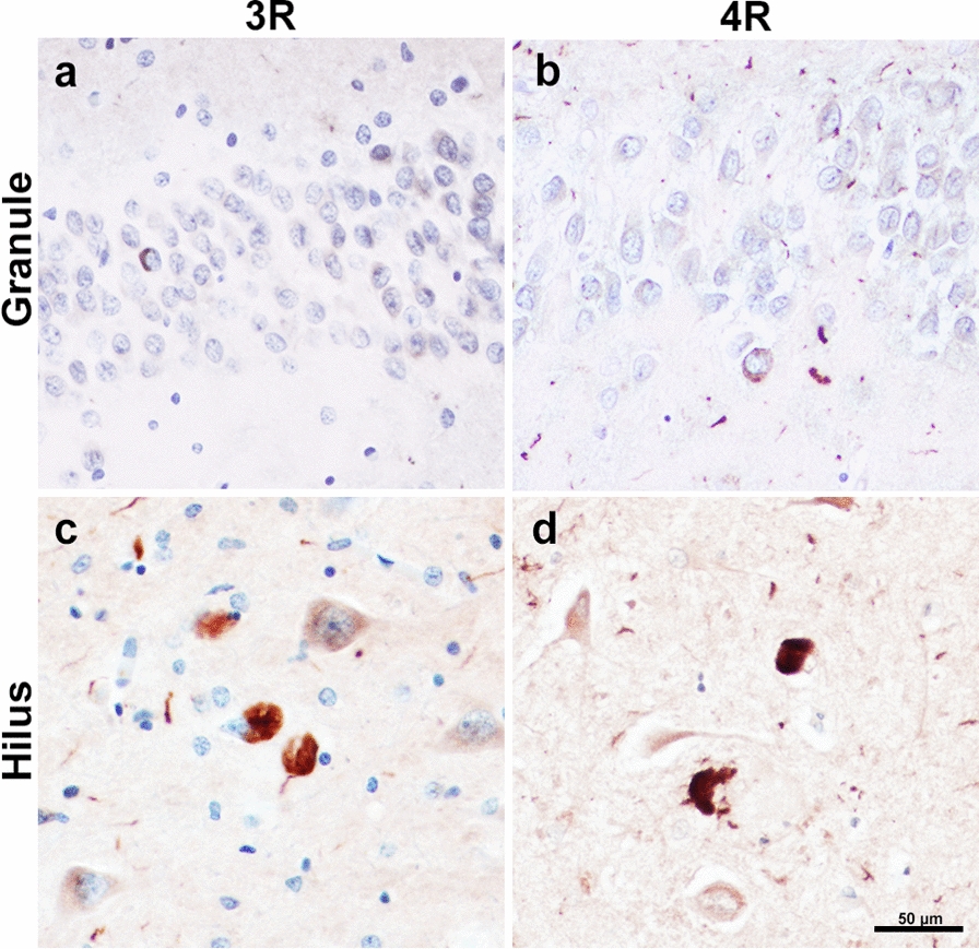 3R- and 4R-tau-positive Inclusions in PPA due to Alzheimer’s Disease. 3R-positive pathology visualized through RD3 immunohistochemical staining in granule (a) and hilar cells (c); taken from case PPA-AD 7. 4R-positive pathology visualized through ET3 immunohistochemical staining in granule (b) and hilar cells (d); taken from case PPA-AD 5. Ratio of stereologic densities revealed ~ 1:1 ratio of 3R-to-4R immunopositivity in the granule cells, and ~ 1.5:1 ratio in hilar cells. Differences in 3R and 4R densities were not significantly different. Scale bar = 50 µm in d, and applies to a–c