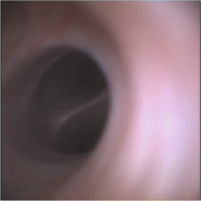 Right and left hepatic duct opening