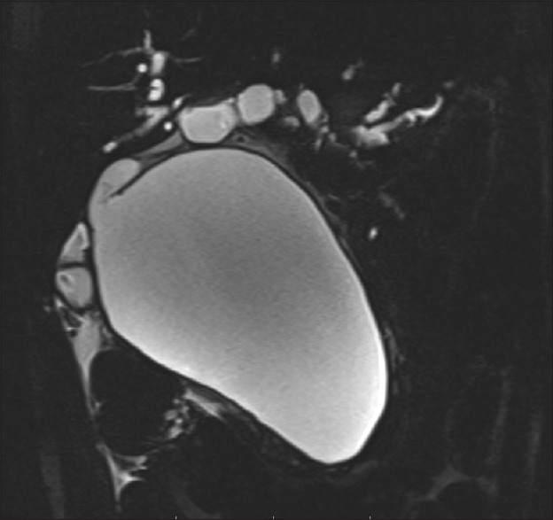 Thick slab image of 35-year-old male of showing choledochal cyst type IVa with changes of obstructive biliopathy as upstream dilatation of CBD, CHD, RHD, LHD and IHBR