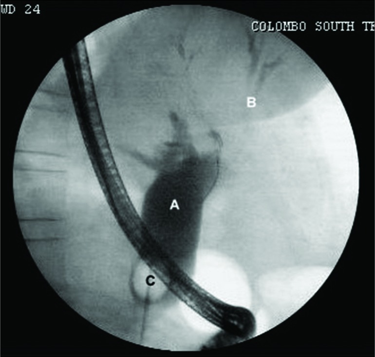 Occlusive cholangiogram of a 42-year-old female patient with Type 1 choledochal cyst complicated with choledocholithiasis. Largely dilated common bile duct (A) without intrahepatic duct dilatation (B) and bulb of the balloon catheter (C) are seen.