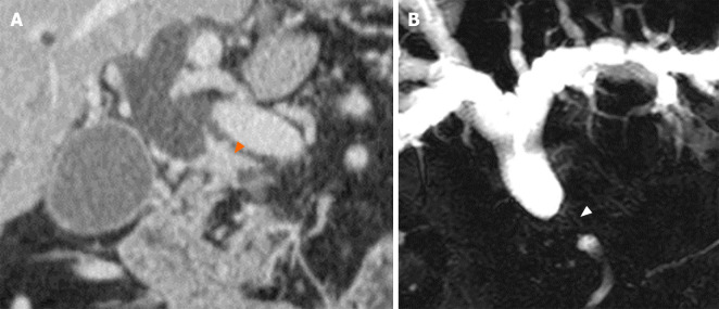 Preoperative imaging. A: Pancreas computed tomography indicates proximal common bile duct (CBD) stricture with wall thickening (arrow head) and marked dilatation of the proximal bile duct and gallbladder; B: Magnetic resonance cholangiopancreaticography also demonstrates short segmental stricture of the proximal CBD (arrow head) with diffuse dilatation of the peripheral bile duct.