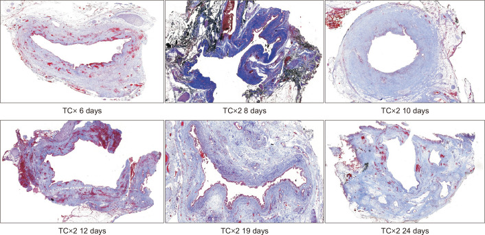 Time course of pericholedochal fibrosis following preoperative biliary drainage. Masson’s trichrome (TC) sections (original magnification, ×2) at various time points (6, 8, 10, 12, 19, and 24 days post-stent placement) reveal that robust PCF is established as early as day 6, with no clear incremental increase in collagen intensity or area at later time points. This suggests a rapid onset and early plateau of the fibrotic response.