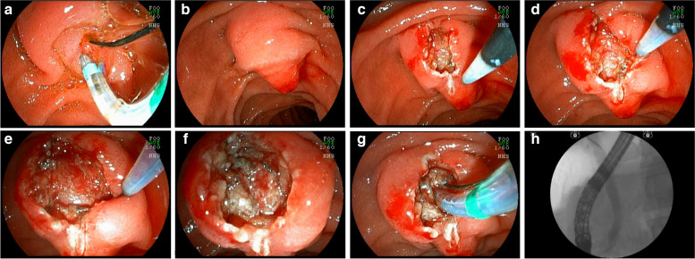 EFP with identification of the muscle tissue. a failed cannulation with the guide wire; b repositioning of the duodenoscope to visualize the infundibulum of the papilla; c Wide longitudinal incision from the transverse crease; d wide lateral incisions; e identification of the muscular sphincter of the papilla; f sectioning the muscular fibers to expose the common bile duct mucosa; g cannulation of the bile duct; h deep cannulation and contrast injection