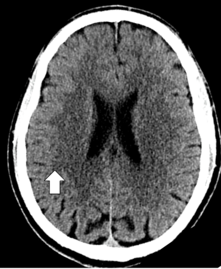 CT head or brain without contrast showing no signs of an acute infarct or hemorrhage with normal grey-white differentiation depicted by white arrow