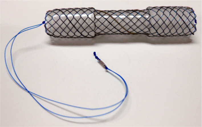 The covered self‐expandable metallic stent (CSEMS) used in this case was the BONASTENT M‐intraductal. The shape of the stent resembles a dumbbell. By pulling a string, the BONASTENT M‐intraductal becomes narrower. Therefore, the CSEMS is easy to remove