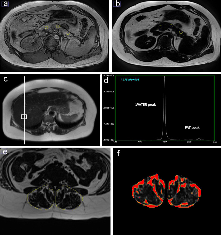 Fat phenotypes measurements for a 78-year-old European man who was never smoker and had low-to-moderate average alcohol consumption. (a, b) Intra-pancreatic fat deposition measurement by region of interest placement in the head, body and tail of the pancreas on out-of-phase and fat images. (c, d) Intra-hepatic fat deposition measurement with placement of the voxel within the liver and spectroscopy data using fat and water signals collected at the time of scan acquisition. (e, f) Skeletal muscle fat deposition measurement with selection of total erector spinae muscle area and quantification of fat pixels using the thresholding function of ImageJ.