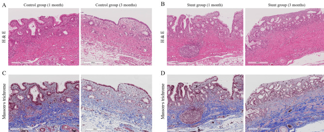 H&E and Masson’s trichrome staining of common bile ducts (CBD) from the control and stent groups. (A,B) H&E staining shows more mucinous gland hyperplasia and lymphoplasmacytic infiltration in the CBD of stent group than that of control group. (C,D) Masson’s trichrome staining of the CBD shows more prominent fibrosis (blue-colored staining of the collagen fibers) in the stent group than in the control group.