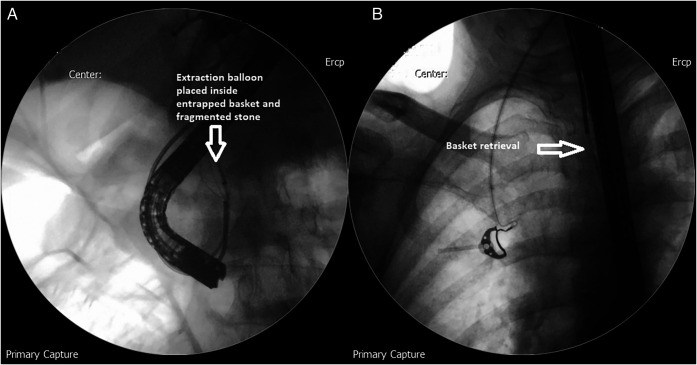 (A) Extraction balloon placed inside the entrapped Dormia basket and fragmented stone to dislodge the entrapped wires. (B) Retrieval of the Dormia basket.