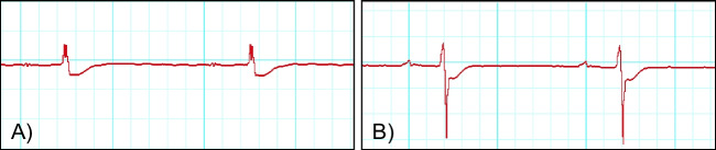 Examples of two hearts presenting ST depressions in the electrocardiogram graphs suggesting cardiac ischemia: A heart of the high dose group; B heart of the low dose group