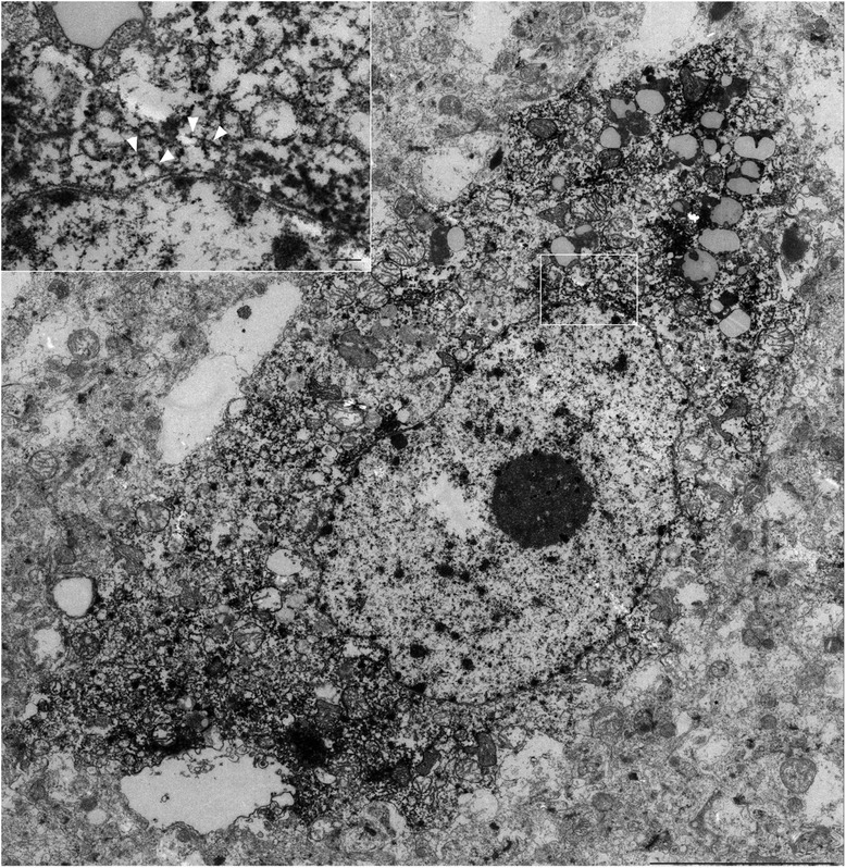 Immunoelectron microscopy of a neuron containing tau-positive signals. Tau immunolabeled filaments (arrowheads) were observed around the nuclear membrane (inset, bar:0.2 μm), although tau-positive deposits were not abundant in neurons (scale bar, 5 μm). For a high resolution image of Fig. 7 please see Additional file 2