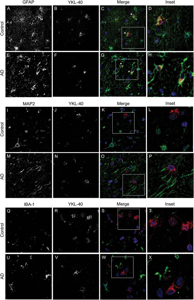 YKL-40 expression pattern in human brain tissue from an AD patient and a healthy control. Representative images of double immunofluorescence performed with YKL-40 (red) and three different cellular markers, GFAP (astroglial, green), MAP2 (neuronal, green) and IBA-1 (microglial, green). Nuclei are marked in blue. a–h YKL-40 immunoreactivity was detected in the cytoplasm of GFAP+ cells (asterisk), indicating an astroglial origin. i–p No colocalization was observed between YKL-40 and the neuronal marker, MAP2 or (q–x) with the microglial marker, IBA-1. Scale bar = 20 μm