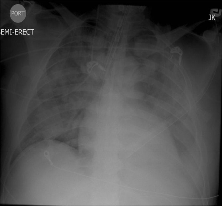 Chest radiography showing bilateral pulmonary infiltrates.