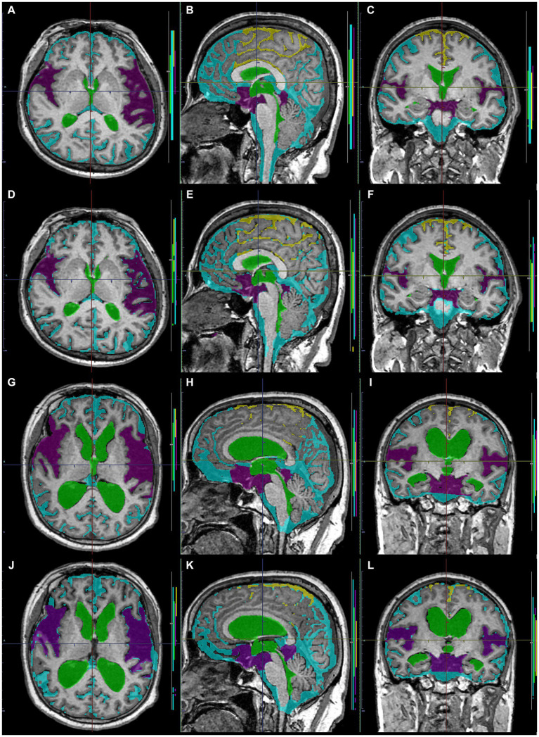 Comparison between manually and automatically segmented regions from 3D T1-weighted images. 3D T1-weighted images in a representative healthy volunteer (A–F) and a representative patient with Hakim disease and DESH (G–L): manually segmented (A–C,G–I) and automatically segmented (D–F,K–L) volumes of the total ventricles (green); Sylvian fissure and basal cistern (purple); high-convexity part of the subarachnoid space (yellow); other subarachnoid spaces (marine blue) from 3D T1-weighted images.