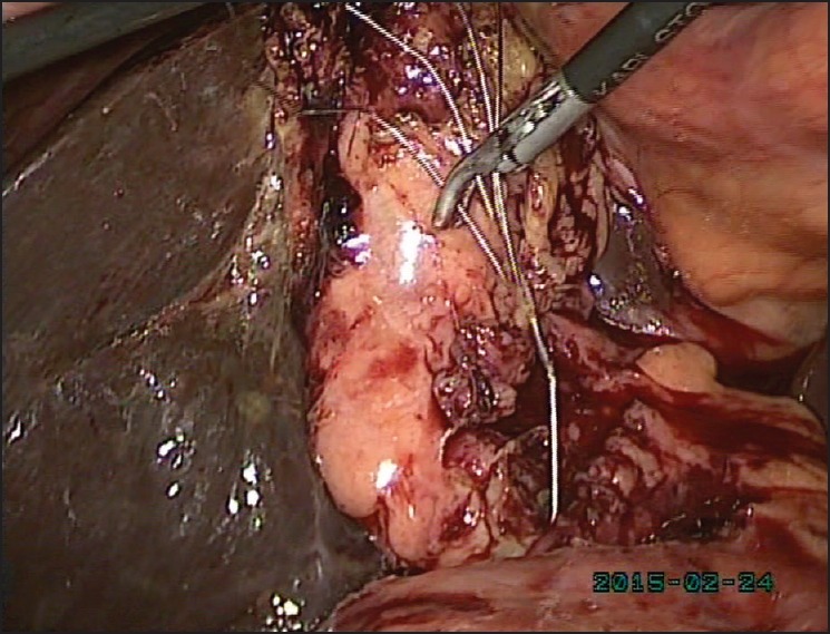 After dislodgement of stone from Dormia basket, basket is being removed through epigastric port by holding its tip with Maryland forceps