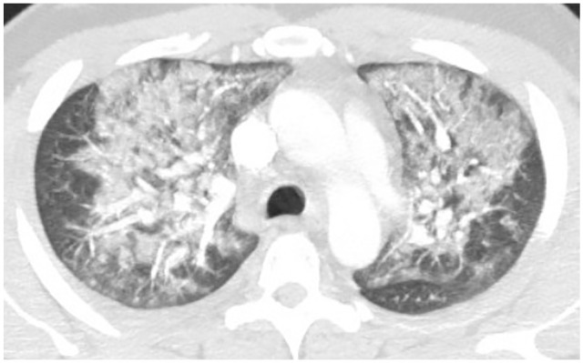 Bilateral upper lobe ground glass opacities centrally distributed.