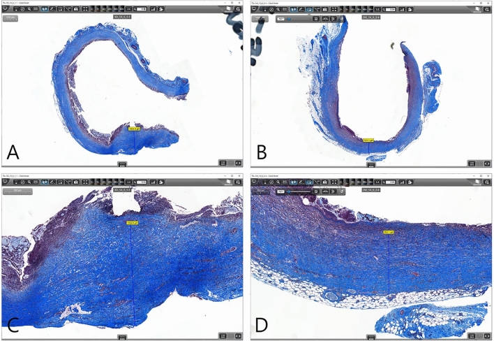 Measurement of periductal fibrosis (fibrous wall thickness). The thickness of bile duct fibrosis was measured using the distance measurement tool in CaseViewer software (3DHistech). The thickest (A) and the thinnest areas (B) were measured in a region of dense collagen deposition under the muscle layer by Masson’s trichrome staining. (C) Magnified image of (A). (D) Magnifified image of (B).