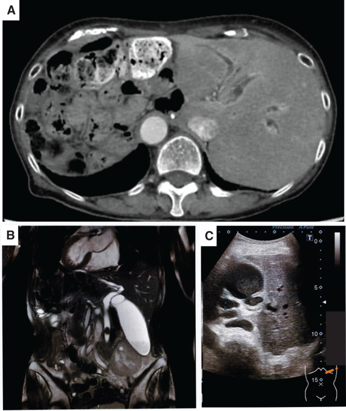 Preoperative imaging findings. (A) Contrast-enhanced CT showing mirror-image positioning of abdominal organs consistent with situs inversus totalis. (B) Magnetic resonance cholangiopancreatography revealing an 18-mm stone within the common bile duct, accompanied by upstream biliary dilation. (C) Ultrasonography demonstrating choledocholithiasis with posterior acoustic shadowing.