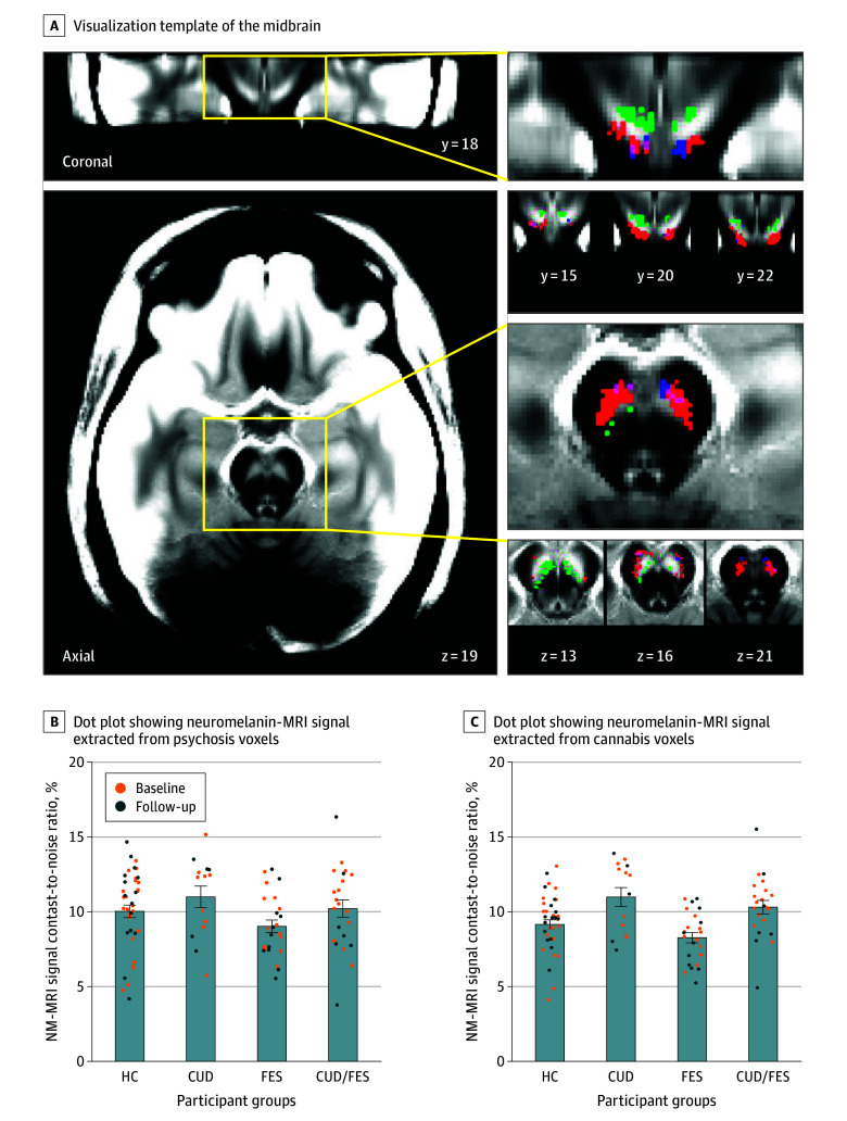 Substantia Nigra/Ventral Tegmental Area Neuromelanin-Sensitive Magnetic Resonance Imaging (NM-MRI) Signal in Participants With Cannabis Use Disorder (CUD) and First-Episode Schizophrenia (FES)A, Visualization template of the midbrain generated by averaging spatially normalized neuromelanin-MRI signal images from study participants. Magnifications show substantia nigra/ventral tegmental area voxels where the neuromelanin-MRI signal was elevated (red) in participants with cannabis use disorder (CUD) compared with individuals without CUD. Psychosis voxels previously shown to correlate with untreated positive symptoms of psychosis are shown in blue (overlap with cannabis-elevated voxels in violet). These voxels were clustered near the cannabis-elevated voxels. Green voxels are where the neuromelanin-MRI signal was reduced in participants with CUD compared with individuals without CUD. B, Dot plots showing the neuromelanin-MRI signal extracted from psychosis voxels in 4 groups, including healthy controls (HCs), those with a CUD, those with FES, and those with both a CUD and FES. Orange dots represent scans collected at baseline and blue dots at follow-up. C, Dot plots showing the neuromelanin-MRI signal extracted from cannabis voxels in 4 groups; orange dots were collected at baseline and blue dots at follow-up. Error bars represent standard error of the mean.