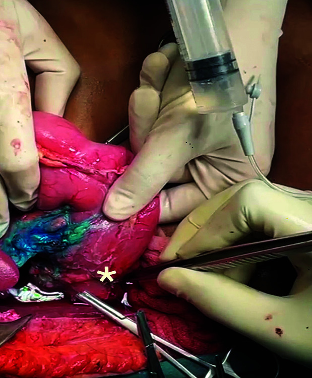 Leak test demonstrating the appropriateness of closure of distal bile duct stump from the superoposterior part of pancreas by injecting saline and air through the IFT secured in the ampulla (arrow = syringe with saline connected to IFT; * = IFT secured in the ampulla with a forceps)