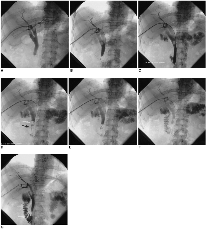 Fourty-three year-old female patient with a common bile duct stone and related right upper quadrant pain. This patient refused endoscopy, due to a terrible experience during a previous endoscopy (A) percutaneous transhepatic biliary drainage is performed, showing a stone in the common bile duct.B. The stone is pushed more distally using a 5 F catheter, and 0.035 inch stiff wire is passed to the duodenum.C. Using a 10 mm dilatation balloon, the ampullary sphincter is dilated.D. 11.5 mm occlusion balloon (white arrow) is inserted into the common bile duct, just proximal to the stone (black arrow).E. Using the occlusion balloon, the stone is pushed into the duodenum.F. The stone is completely pushed into the duodenum.G. The stone is shown in the duodenum (arrow).