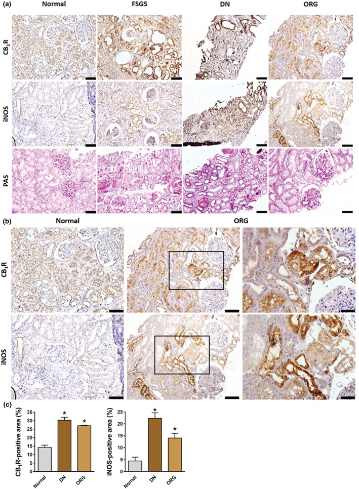 Elevated renal CB1 receptor (CB1R) and inducible NOS (iNOS) protein expression in humans with chronic kidney disease. (a) Elevated protein expression levels of CB1 receptors and iNOS were detected in 25 kidney biopsies from focal segmental glomerulosclerosis (FSGS), diabetic nephropathy (DN), and obesity‐related glomerulopathy (ORG) patients. (b, c) CB1 receptors and iNOS are highly expressed in the kidney tubules in DN and ORG. Scale bar, 100 μm in all images except for the right panels in (b), where the scale is 50 μm. Data represent the mean ± SEM from six normal, eight DN, and 10 ORG kidney samples. * P < .05, significantly different from normal kidney; one‐way ANOVA, followed by a Bonferroni post hoc test