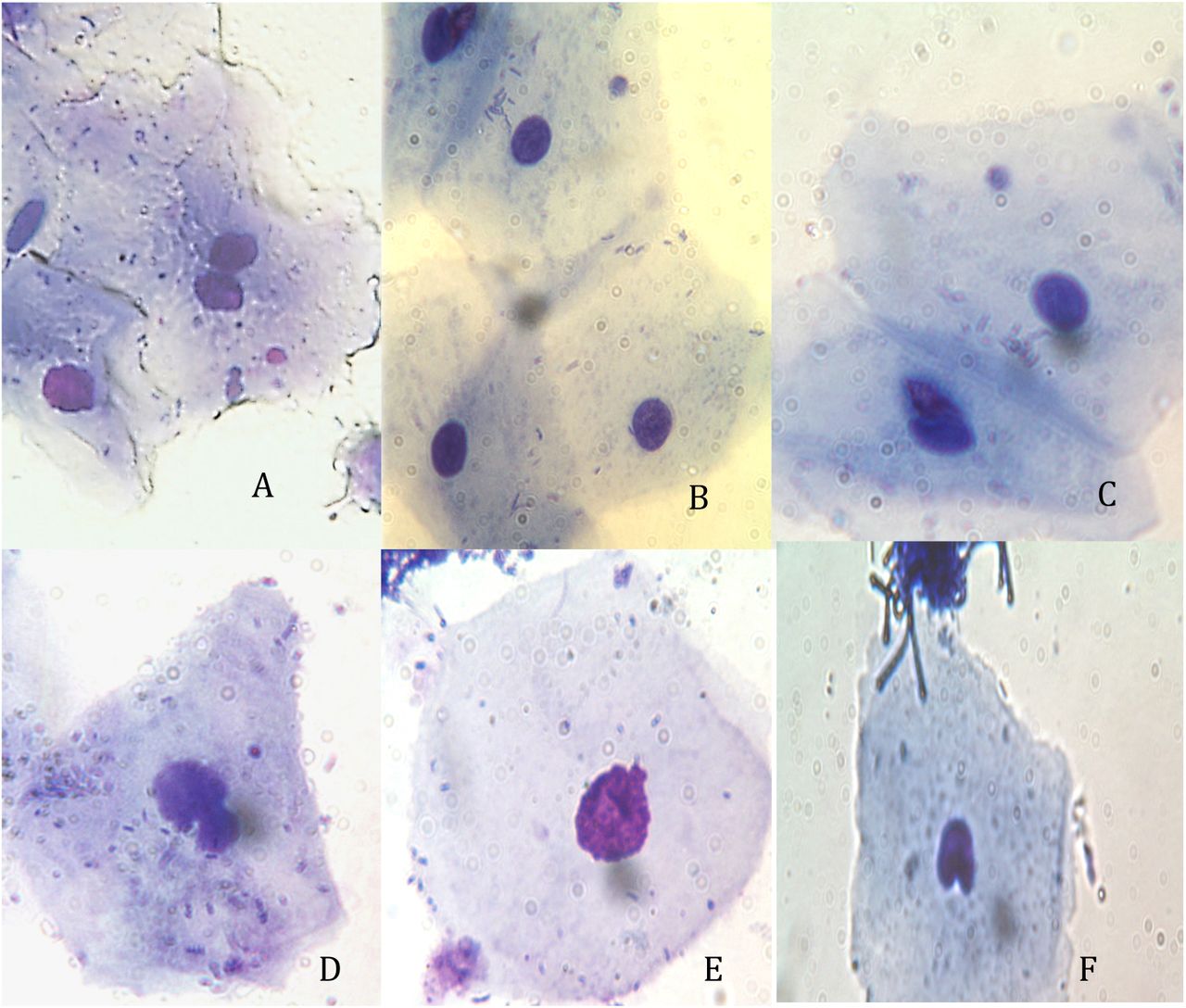 Examples of damaged cells observed in our samplesA) Binucleated cell with micronucleus; B) and C) mononucleated cells with micronucleus; D), E) nuclear buds; F) identation. These last two aberrations were included in the Rearrangement category.