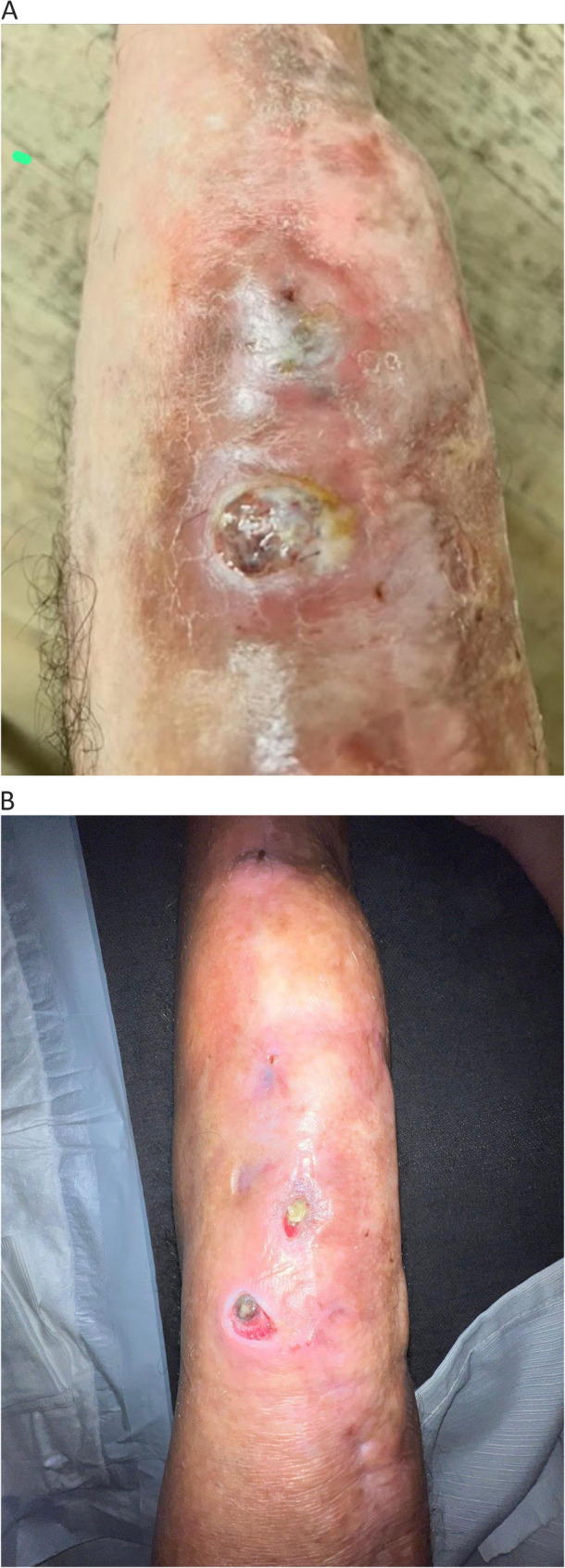Clinical photographs of the left knee showing resolution of the chronic draining fistula and reduced periprosthetic inflammation. A Prior to medical cannabis initiation (January 2025); (B) After 8 months of medical cannabis therapy (September 2025)