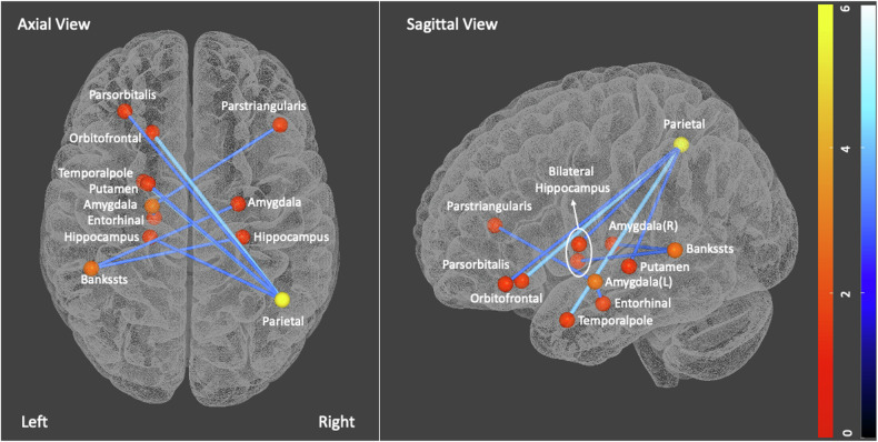 Network-Based Statistics results-structural connectivity differences between CUD and healthy controls.Individuals with CUD showed increased strength across 12 nodes and 9 edges within frontoparietal networks and subcortical regions. The strength of nodes (number of connections with other nodes) is indicated by orange-red colour bar, and edges depicted in blue to dark blue.